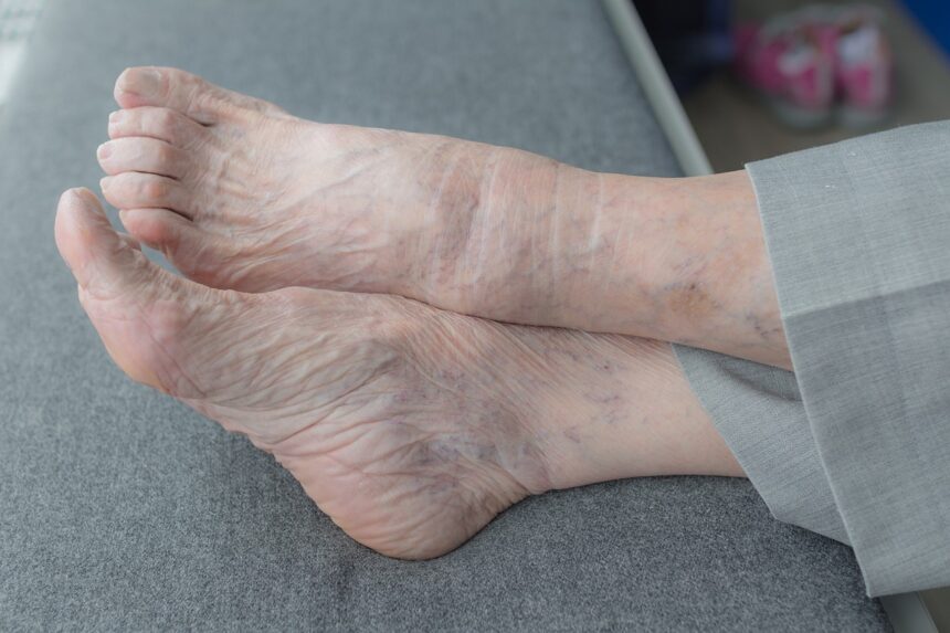 Alles over voetzorg bij de ziekte van Parkinson